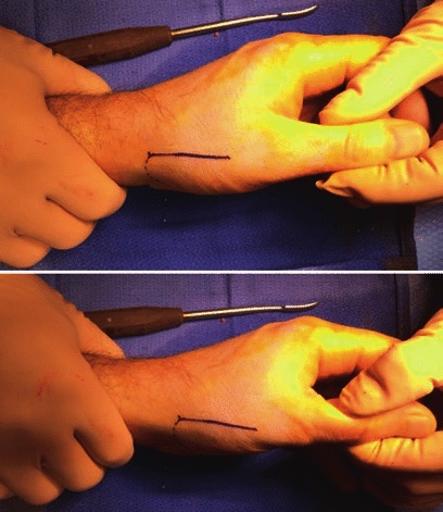 "Screw-home-torque" technique. Image from Obert, Laurent & Menu, Gauthier & Lepage, Daniel & Loisel, François. (2018). Bennett Fracture and Fracture of Trapeziometacarpal Joint of the Thumb. 10.1007/978-3-319-68628-8_28.